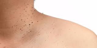 Verrugas Que Son Y Como Se Deben Tratar