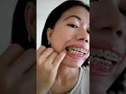 You might experience braces wire bent. I Cut My Braces Wire Using A Nail Cutter Youtube