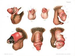 Image result for chancroid