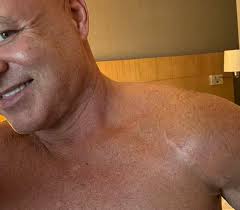 Anyone still have a scar? 😬😅