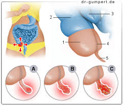Etwa 130.000 davon werden pro jahr durchgeführt.1 der chirurgische eingriff gilt als wirksame behandlung. Diagnostik Und Therapie Der Blinddarmentzuendung