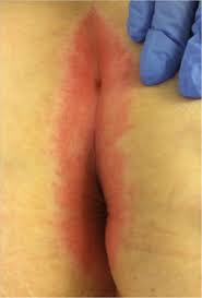 Image result for itchy skin rectum
