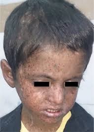 updated 2018 nov 30, cited place cited date here. Xeroderma Pigmentosum In Children Report Of 4 Cases Health Scope Full Text