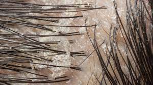 Penyebab masalah kulit kepala kering & cara mengatasinya. Kulit Kepala Gatal Dan Bersisik Waspada Penyakit Dermatitis Seboroik