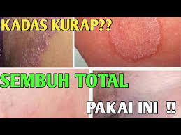 Viraaalll Sekali Pakai Kadas Kurap Langsung Sembuh Selamanya Youtube