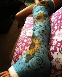 Cast Art Leg Design Because Signing A Cast Is Overrated Arm Cast Cast Decoration Cast Art