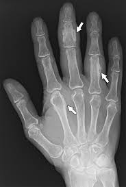 Image result for periostitis