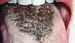 Image result for بیماری زبان جغرافیایی