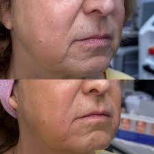 We're so excited to officially welcome Dr. Susan Baskin to Peaceful Body  Spa 🤍 Dr. Baskin began seeing clients this week, bringing her expertise in  cosmetic injectables to our space — and