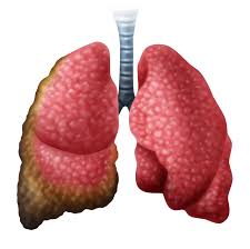 Pericardial mesothelioma is a highly lethal and very rare form of the cancer, accounting for roughly 1 percent to 5 percent of all new cases. Can Mesothelioma Be Benign Lung Cancer Pintas Mullins Law Firm