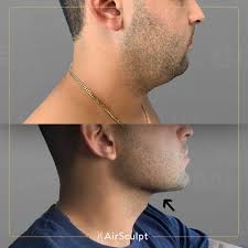 He specializes in procedures such as rhinoplasty (commonly known as a ‘nose … The Best 10 Cosmetic Surgeons In Sacramento Ca Last Updated April 2022 Yelp