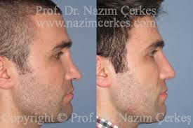 Maybe you would like to learn more about one of these? Revision Nose Surgery Rhinoplasty Before After Pictures Male Rhinoplasty Nose Surgery Breast Face Body Aesthetics Prof Dr Nazim Cerkes
