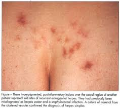 The symptoms of herpes on your buttocks are like symptoms everywhere else.they differ greatly with each person. Isolated Thigh Lesion Bug Bite Or Herpes Document Gale Academic Onefile