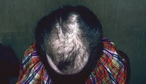The Most Common Causes Of Hair Loss Among Women Clinical Advisor