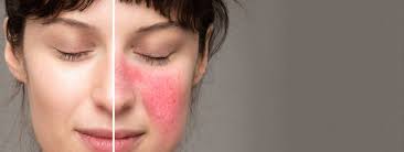 10 Skincare Tips for Managing Rosacea Flares