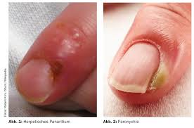 Image result for paronychium