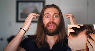 Daily hairstyles for reducing reclining hairline female : Daily Hairstyles For Reducing Reclining Hairline Female Pin On Natural Hair Info Styles Daily Hairstyles For Reducing Reclining Hairline Female Balding Woman Gets Confidence Back Thanks To Hair Tattoo Daily