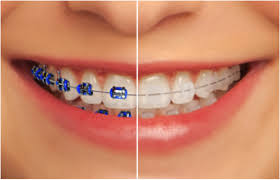 Braces Colors Teeth Braces Colors And Tooth Colored Braces Ceramic Braces Teeth Braces Braces Teeth Colors