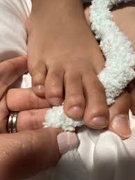 Image result for Clubbing nails feet