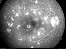Meaning of apmppe medical term. Apmppe In A 21 Year Old Female Patient Retina Image Bank