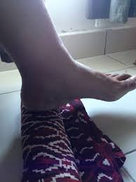 Cara tepat atasi nyeri tumit dan telapak kaki dengan mengkonsumsi qnc jelly gamat. Petua Tradisional Pulihkan Sakit Tumit Boleh Sarankan Cara Ini Pada Ibu Mentua Keluarga