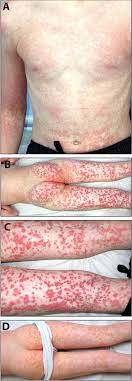 Petechiae definition petechia is actually a spot on your skin that may be red to purple in color. Pdf Petechiae And Purpura The Ominous And The Not So Obvious Semantic Scholar
