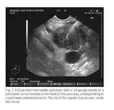 The stage of cancer refers to how far it has spread throughout a biopsy can be performed in the following ways Endoscopic Ultrasound In The Diagnosis And Staging Of Pancreatic Cancer