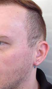 Earlobe Repair Orland Park Plastic Surgery