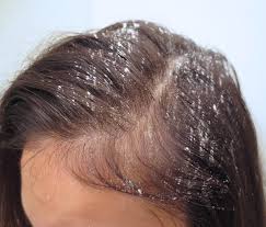 Your scalp is trained to produce a certain amount of oil depending on how often you wash your hair. How To Get Rid Of Greasy Hair Without Using Dry Shampoo How To Survive Bad Hair Days