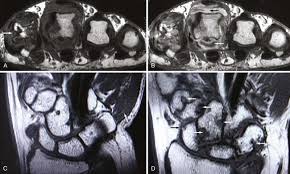 Image result for XRay Changes in Rheumatic Conditions
