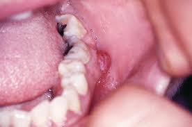 Image result for granuloma gum disease