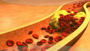 علاج نهائي للكوليسترول painting art