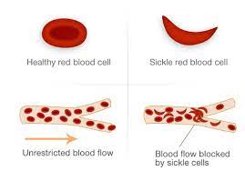 Sickle cell disease is the umbrella term for a group of inherited conditions that severely affect red blood cells. Sickle Cell Disease Tif