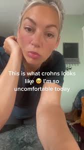 #crohns #bloated #ibd