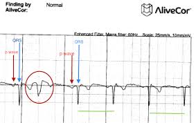 552 x 349 jpeg 52 кб. Are Your Palpitations Due To Benign Premature Ventricular Contractions Pvcs The Skeptical Cardiologist