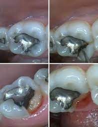 Friends Don T Let Friends Chew On Ice So You Don T Have To Go To Your Friendly Dentist And Get A Crown Dental Life Dental Care Dental
