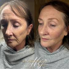 Full Face Rejuvenation ✨ When it comes to facial balance, it's never about  changing how you look — it's about enhancing what's already beautifully  yours. 💫 Using advanced filler techniques, we restore