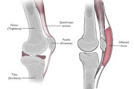 After removing fluid from knees, arthrocentesis is used to study bacteria, measure cell count, and check for crystals, such as calcium pyrophosphate dihydrate crystals. Prepatellar Kneecap Bursitis Orthoinfo Aaos