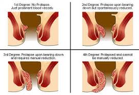 Image result for Hemorrhoid