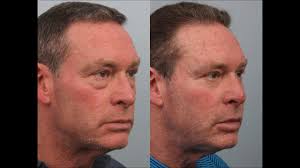 Male Blepharoplasty By Dr Edwin Williams Eyelid Surgery Male Eye Lift