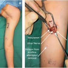 Lol of any of you had the nexplanon/implanon implant bc how long did it take to conceive after removal? Pdf Peripheral Nerve Injury With Nexplanon Removal Case Report And Review Of The Literature