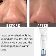 Pigmentation dark spots before and after herbalife skin care products. Real Results Order Yours Today Artistry Amway Artistry Skin Care Skin Care