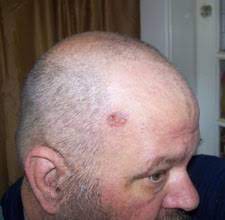 A year ago, my son noticed a pimple on my forehead. Chris Dewald Skin Cancer