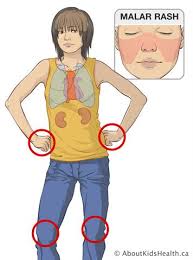 Lupus erythematosus, an autoimmune disorder that causes chronic inflammation in various parts of the body. Lupus Systemic Lupus Erythematosus