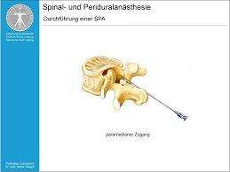 Abteilung für anästhesie und intensivmedizin bezirkskrankenhaus schwaz. Anasthesie Famulatur Curriculum Spinalanasthesie Spa Periduralanasthesie Pda Pdf Free Download