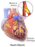 Image result for icd 10 code for hx of myocardial infarction