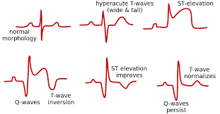 Image result for ST Elevation