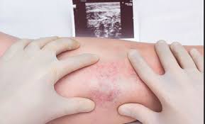 This website is intended to provide information to an international audience outside the usa and uk. Que Es La Trombosis Venosa Profunda Revista Salud Y Cardiologia