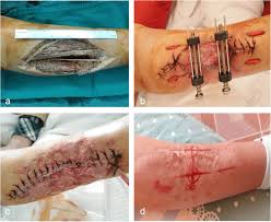 Skin and Soft Tissue Defects