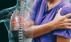 Discover 10 common lung cancer symptoms at 10faq health and stay better informed to make healthy living decisions. Lung Cancer Symptoms Shoulder Pain Is A Sign You Might Not Recognise Express Co Uk